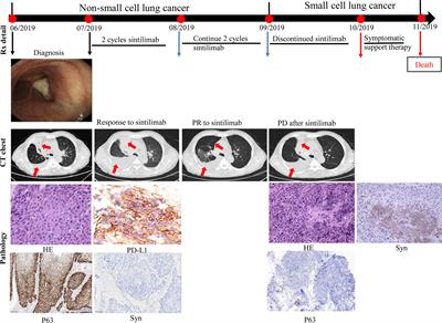 Case Report: Transformation From Non-Small Cell Lung Cancer to Small Cell Lung Cancer During Anti-PD-1 Therapy: A Report of Two Cases